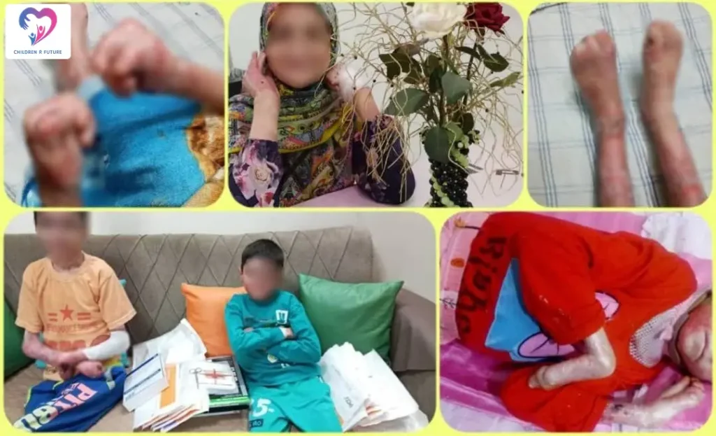Epidermolysis Bullosa (EB) Children